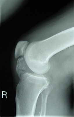 Рентгенограмма колена пациента, больного остеохондромой. Видно окостенение околосухожильных тканей