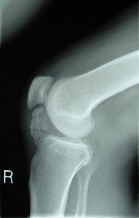 Lateral radiograph of the knee demonstrating ossification in the peritendinous tissues in a patient with osteochondroma.