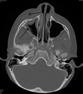 Thumbnail for Periorbital cellulitis