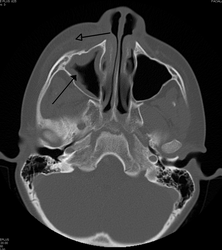 Periorbital cellulitis caused by a dental infection (also causing maxillary sinusitis)