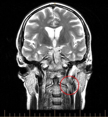 English: MRI image of a patient with CCSVI. Di...