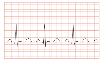 Tachycardia ECG paper.svg