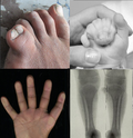 Thumbnail for Tibial hemimelia-polysyndactyly-triphalangeal thumb syndrome