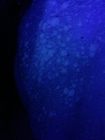 Wood's lamp: fluorescence of pityriasis versicolor