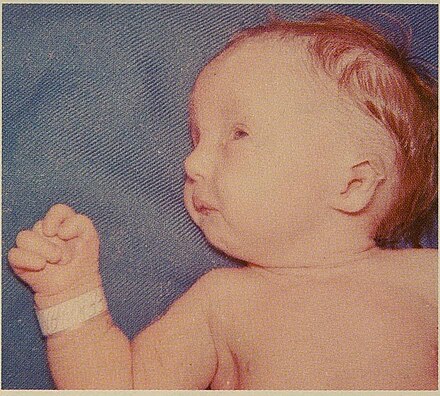 Infant with trisomy 18