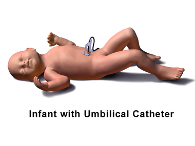 Umbilical Catheter.png