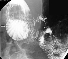 Upper gastrointestinal series showing extreme duodenal dilation (white arrow) abruptly preceding constriction by the SMA.