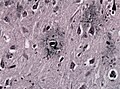 Plăci senile văzute la microscop (impregnare argentică)