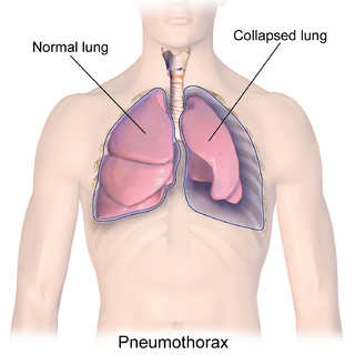 Pneumothorax Abnormal collection of air in the pleural space