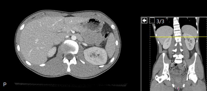 CT of a normal abdomen and pelvis, axial plane 85.png