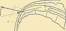 caudal anesthesia technique