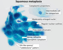 Squamous metaplasia of the cervix, with typical features. Pap stain. Cytology of cervical squamous metaplasia.png