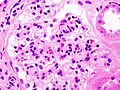नेफ्रोटिक सिंड्रोम के साथ मधुमेही ग्लोमेरुलोस्केलेरोसिस की हिस्ट्रोपैथोलॉजीकल छवि.अन्य ग्लोमेरूलास.एच एंड ई धब्बा.