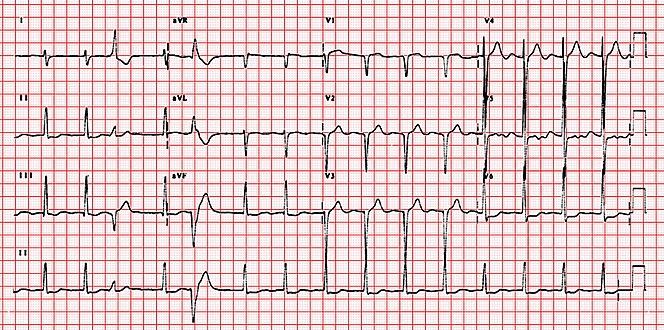 ECG showing right axis deviation