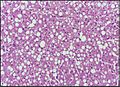 Fatty change liver - Lipid steatosis 10X.jpg