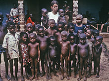 Nigerian orphanage in the late 1960s Kwashiorkor 6903.jpg