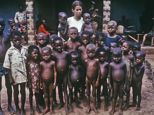 Veel kinderen op deze foto uit een Nigeriaans weeshuis eind 1960 vertonen verschijnselen van ondervoeding, waarvan er vier grijsblond haar hebben als gevolg van kwashiorkor.