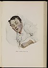 Man suffering from typhoid. Baumgartner, 1929 Wellcome L0074316.jpg