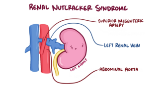 The nutcracker syndrome (NCS) results most commonly from the compression of the left renal vein (LRV) between the abdominal aorta (AA) and superior mesenteric artery (SMA), although other variants exist. The name derives from the fact that, in the sagittal plane and/or transverse plane, the SMA and AA appear to be a nutcracker crushing a nut. Furthermore, the venous return from the left gonadal vein returning to the left renal vein is blocked, thus causing testicular pain .
There is a wide spectrum of clinical presentations and diagnostic criteria are not well defined, which frequently results in delayed or incorrect diagnosis.
This condition is not to be confused with superior mesenteric artery syndrome, which is the compression of the third portion of the duodenum by the SMA and the AA.
