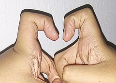 Unilateral extra phalangeal crease