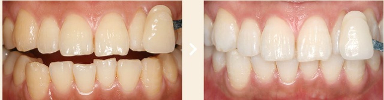 Pittig Promotie Onderling verbinden tanden bleken