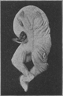 Case of acephalus holoacardiacus - born without a head. Was birthed alongside a healthy twin. Acephalus Boulgakow 1.jpg
