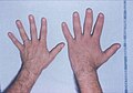 July 31: the right hand shows acromegaly