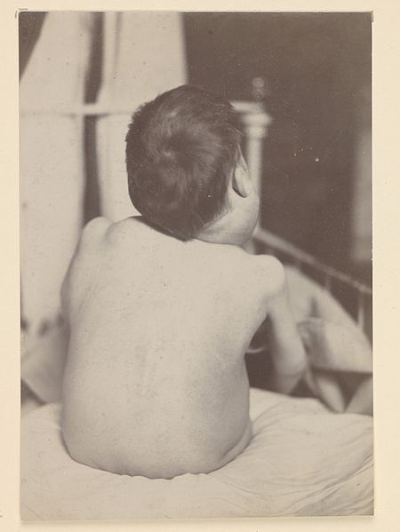 File:Boy affected by large lymphadenomatous growths Wellcome L0062839.jpg