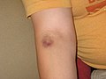 Bruise on arm