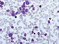 Thumbnail for Chronic myelomonocytic leukemia