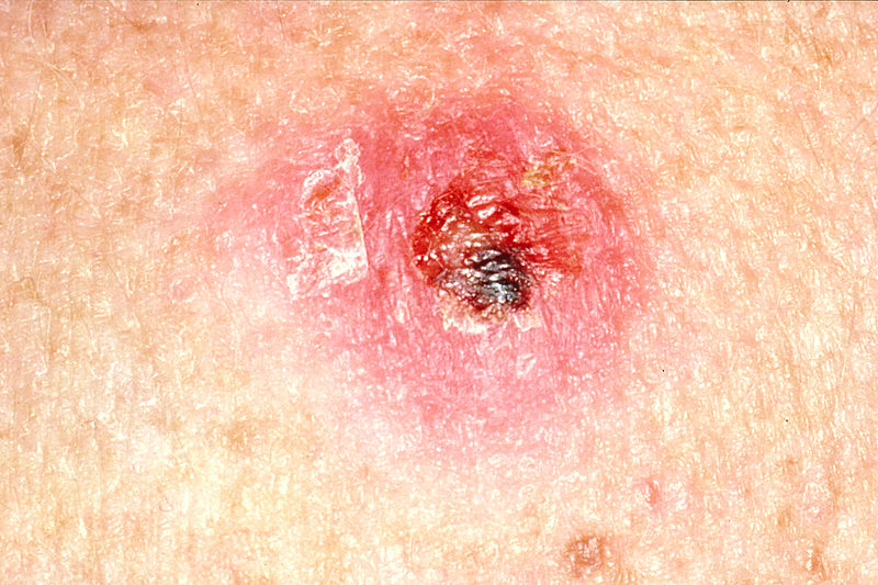 File:Crusty skin lump.jpg