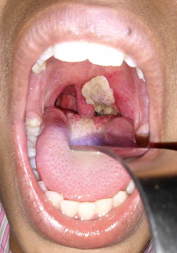 An adherent, dense, grey pseudomembrane covering the tonsils is classically seen in diphtheria.