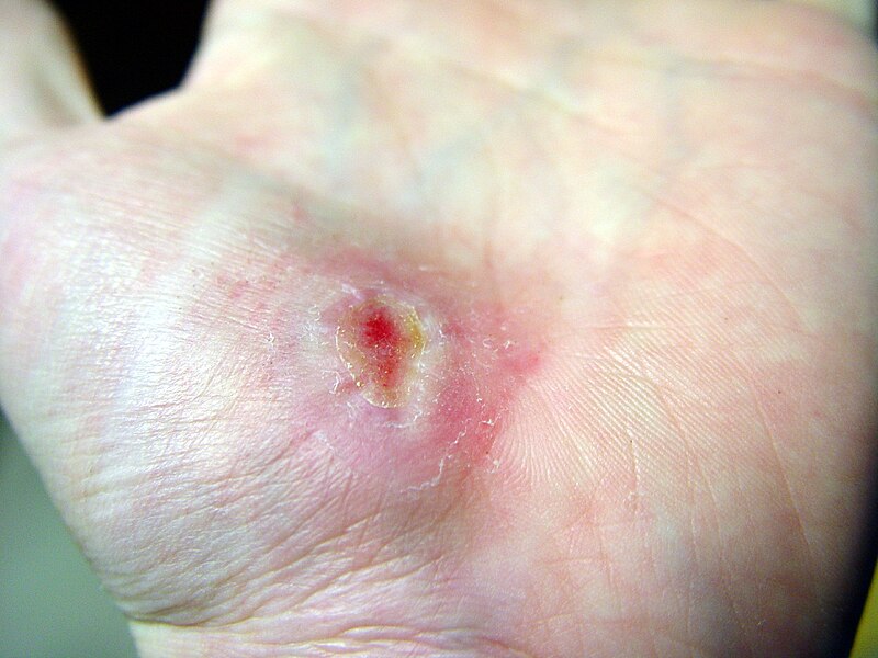 File:Hand Abrasion - 18 days 11 hours 43 minutes after injury.JPG