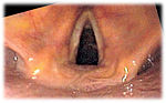 Thumbnail for Laryngoscopy