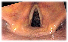 Endoscopie du larynx, avec les cordes vocales.