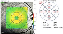 Ocular OCT retinal thickness map, right eye OCT OD Retinal Thickness Map.jpg