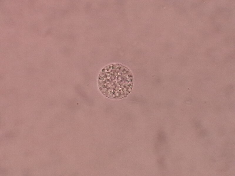 File:Oval Fat Bodies in Urine Microscopy.jpg