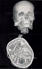 3-D CT scan showing a penetrating head injury by a screwdriver Penetrating skull fracture.jpg