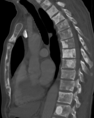 Sclerosis of the bones of the thoracic spine due to prostate cancer metastases (CT image)