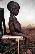 A child suffering the effects of severe hunger and malnutrition during the Nigerian blockade of Biafra 1967-1970. Starved girl.jpg