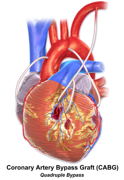 File:Blausen 0154 CABG Quadruple.png