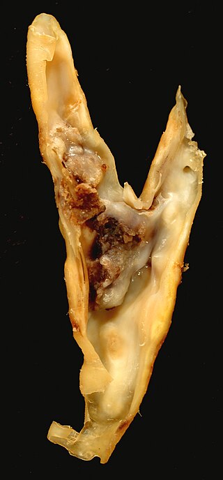 <span class="mw-page-title-main">Atheroma</span> Accumulation of degenerative material in the inner layer of artery walls