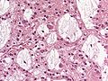 Thumbnail for Dysembryoplastic neuroepithelial tumour