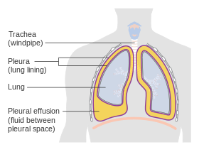 Diagram showing a build up of fluid in the lining of the lungs (pleural effusion) CRUK 054.svg