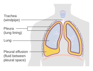 Description de l'image Diagram showing a build up of fluid in the lining of the lungs (pleural effusion) CRUK 054.svg.