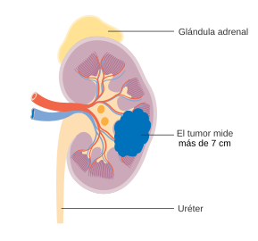 Cáncer de riñón en etapa 2