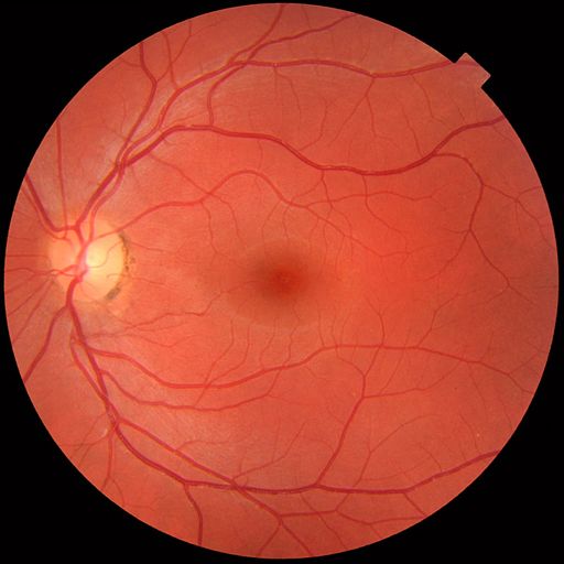 Fundus photograph of normal left eye