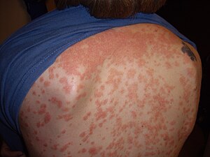 guttate psoriasis meaning in marathi)