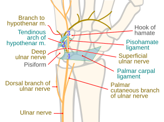 Three locations (zones) in which the ulnar nerve can be compressed within Guyon canal Guyon canal syndrome zones.svg
