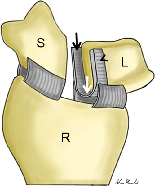 File:Illustration of scapholunate interosseous ligament anatomy.png